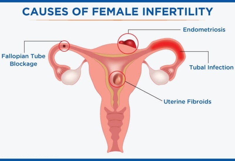 Infertility Management